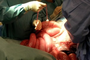 colic-surgery